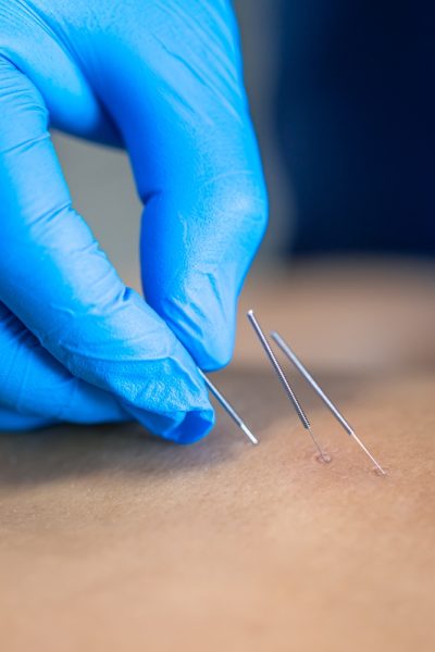 Close,Up,Of,A,Needle,And,Hands,Of,Physiotherapist,Doing